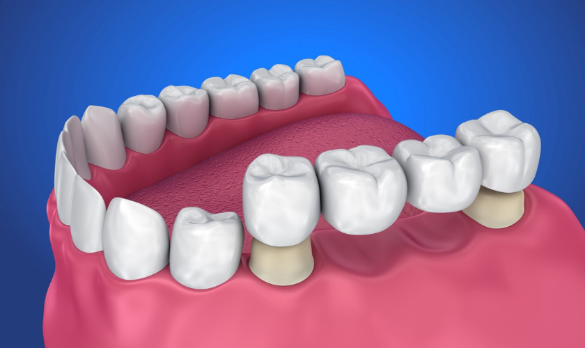 dental restoration treatment for cavities and damaged teeth
